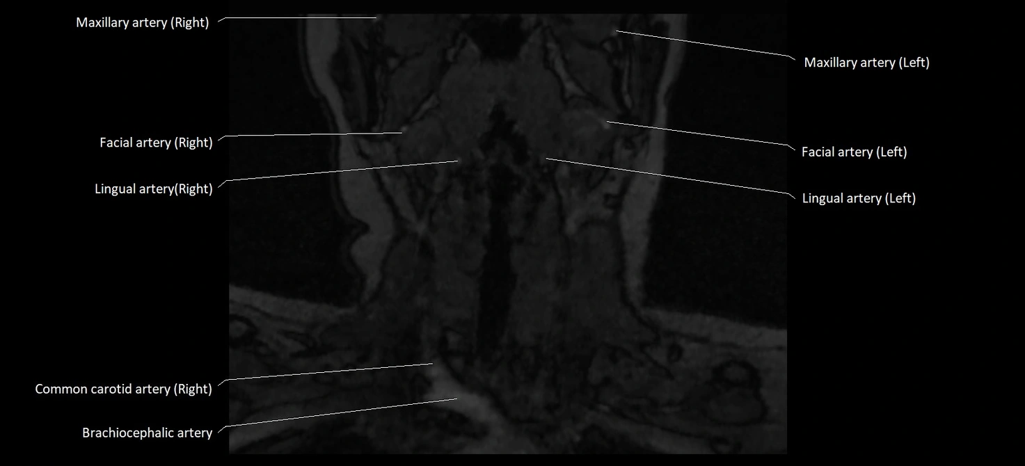MRA carotid artery anatomy cross sectional 3T coronal image 2.webp